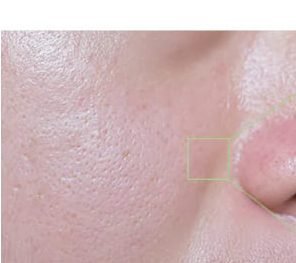 Visible enlarged pores beside the nose